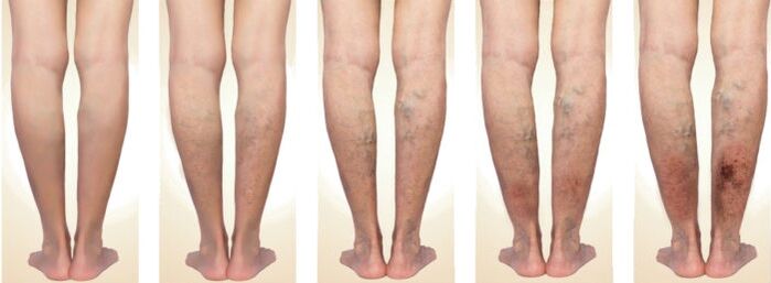 stages of varicose veins development