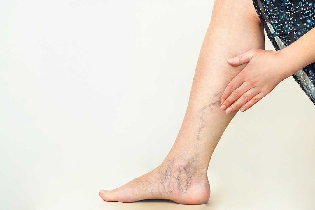 varicose vein symptoms