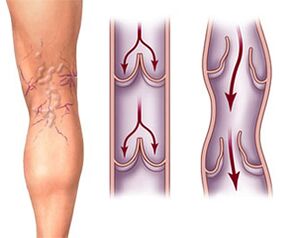 Normal valve function in a healthy vein and valve pathology in a varicose vein