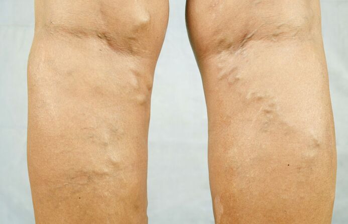 Varicose veins on the legs are a reason to consult a phlebologist