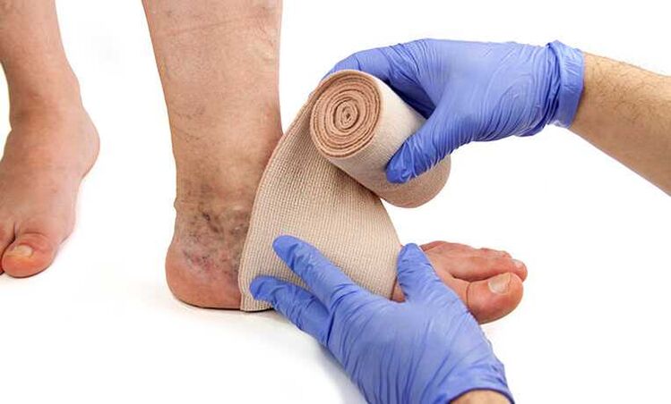 The treatment of varicose veins in the legs is complemented with the use of compression stockings