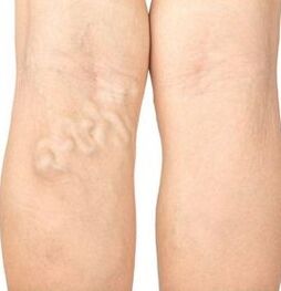 Varicose veins symptoms