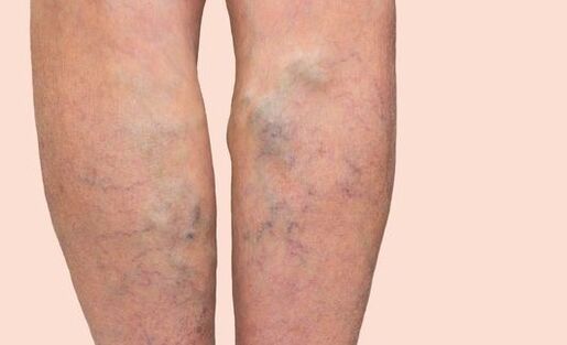 Varicose veins