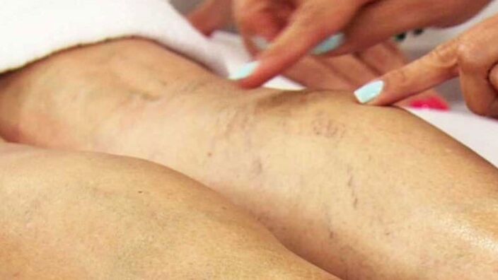 Varicose veins from the lower ends