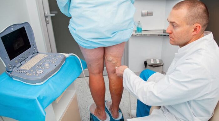 Varicose veins