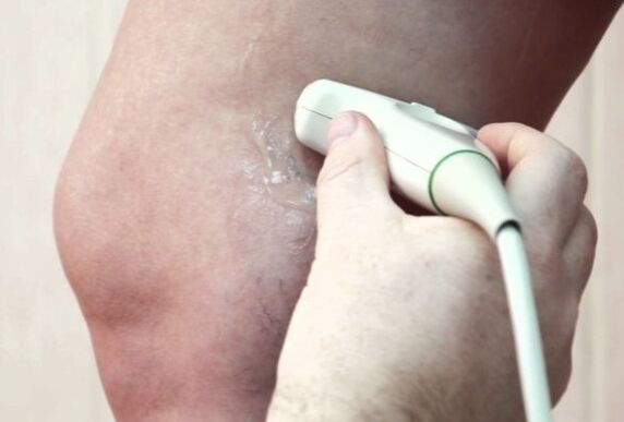 Varicose veins