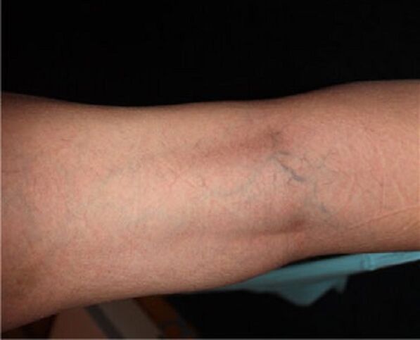Varicose veins symptoms