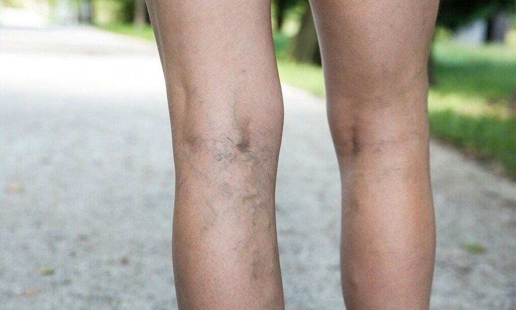 Varicose veins