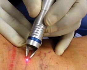 As laser treatment of varicose veins is performed