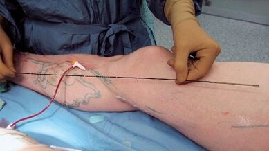 How surgery for varicose veins is performed