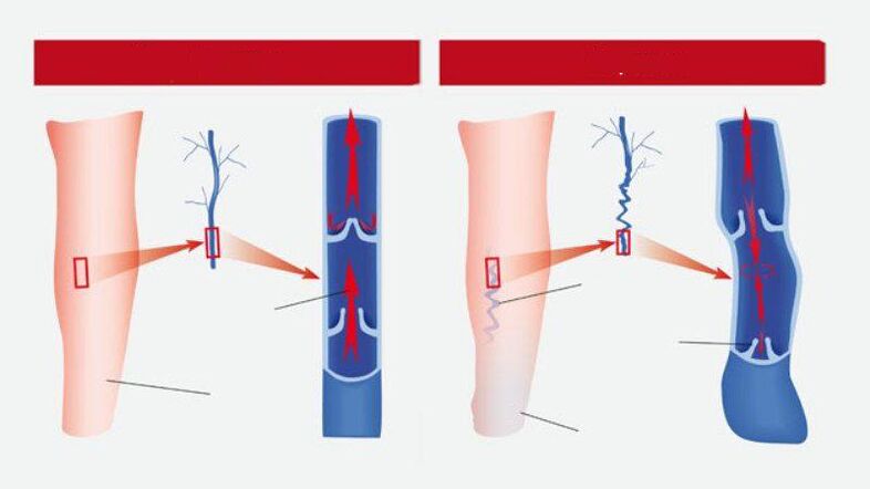How are veins varicose veins