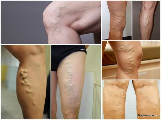 What are the veins varicose veins